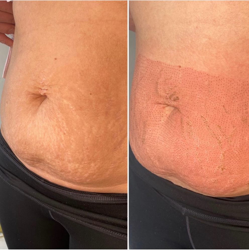 Abdomen Tightening Fibroblast