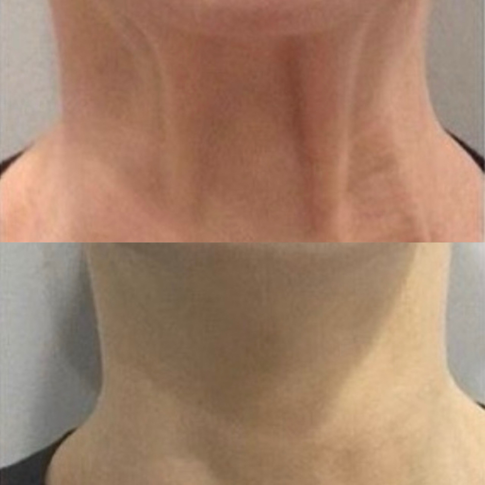 Tox-DAXXIFY Platysmal Band (Neck)