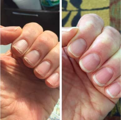 “Healthy Nail Break Program