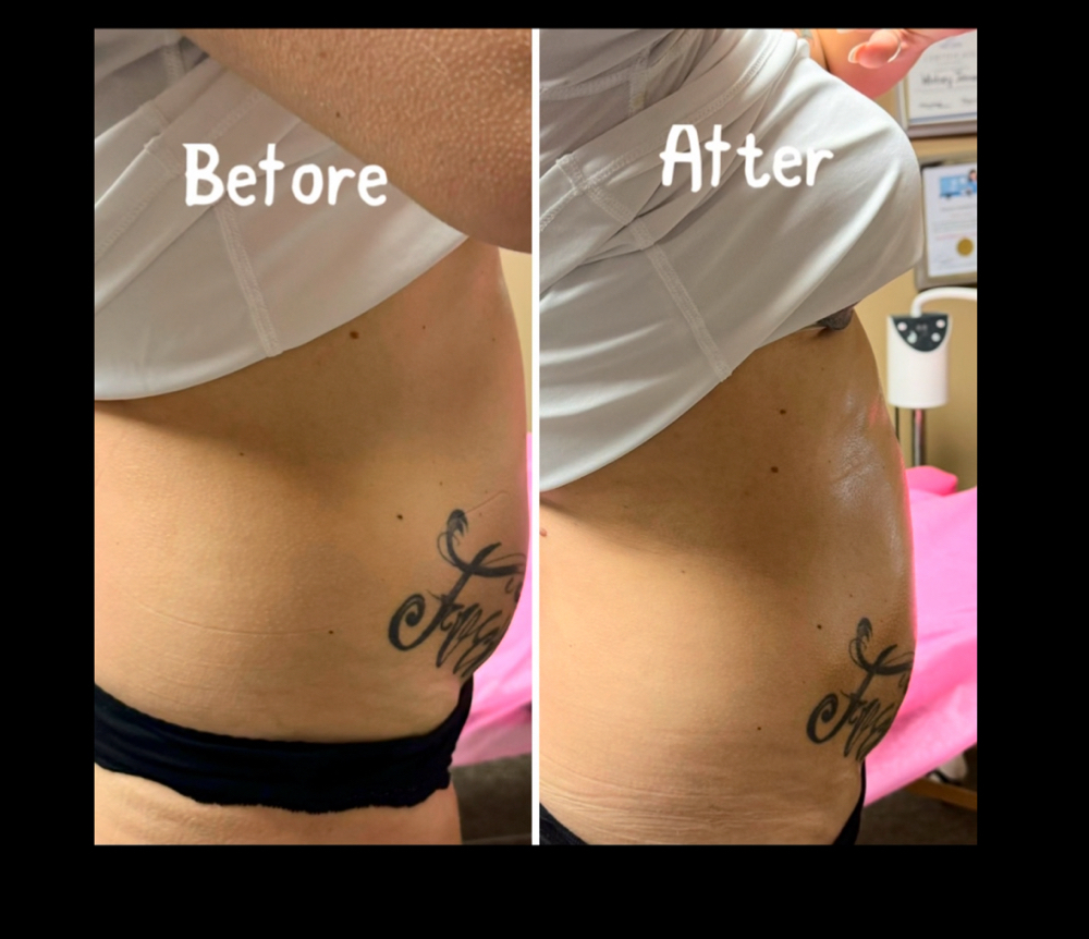 Fat Melting /Body Sculpting