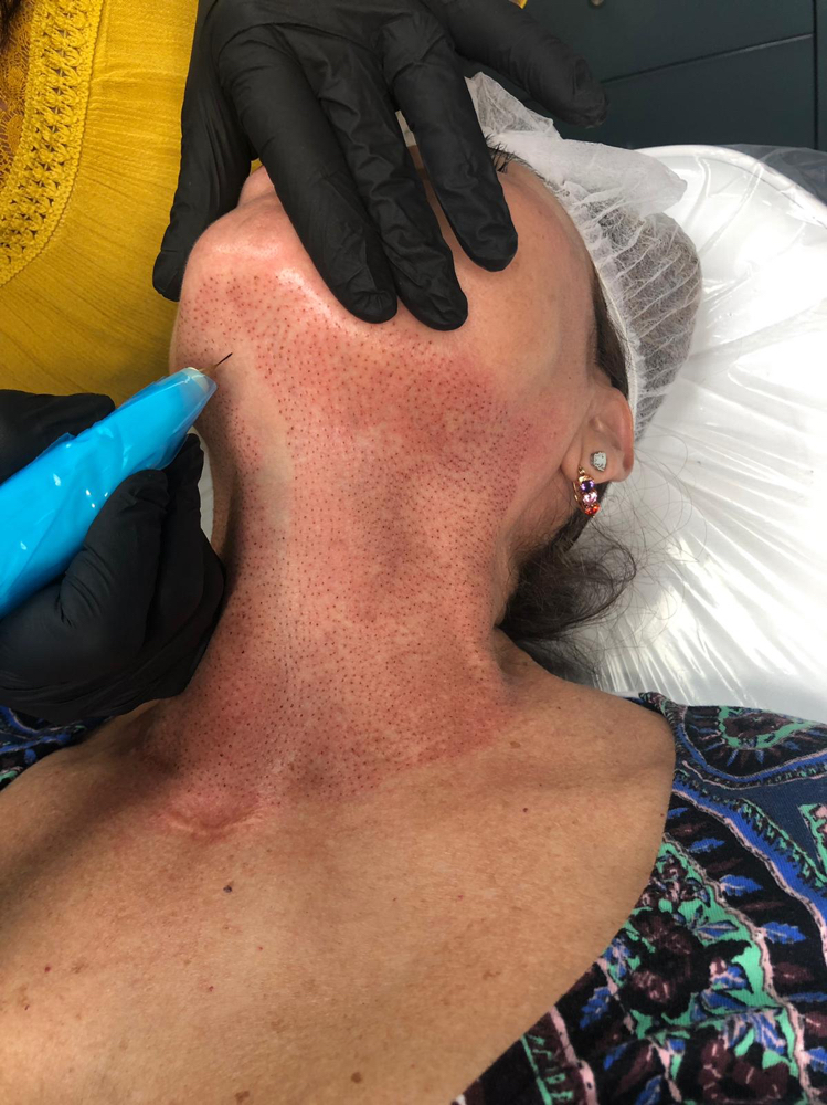Fibroblast Neck at Leidy Cornelio Spa in Aurora, CO