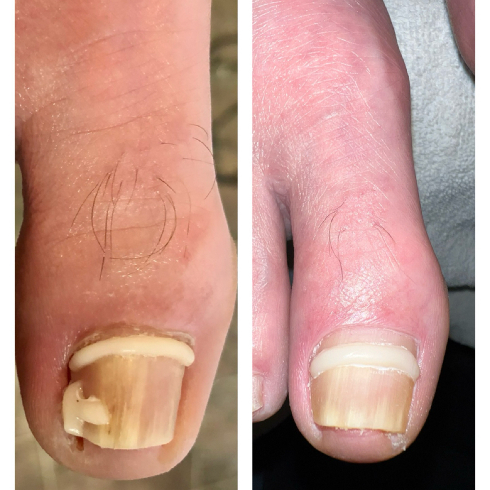 Onyfix at Nailz Now in Harvey, ND