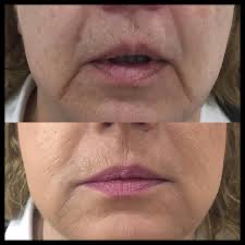 Hialuronic Fillers For Marionette
