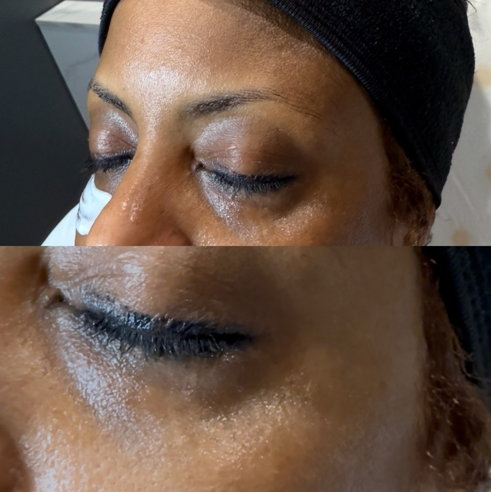 Under Eye Treatment