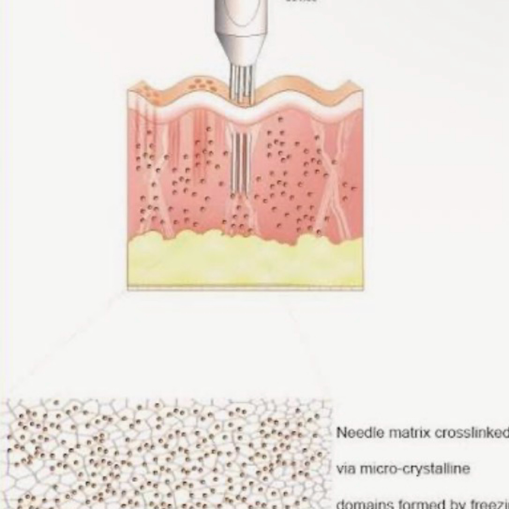 MicroNeedle at Elevate Beauty Lounge in Davenport, IA