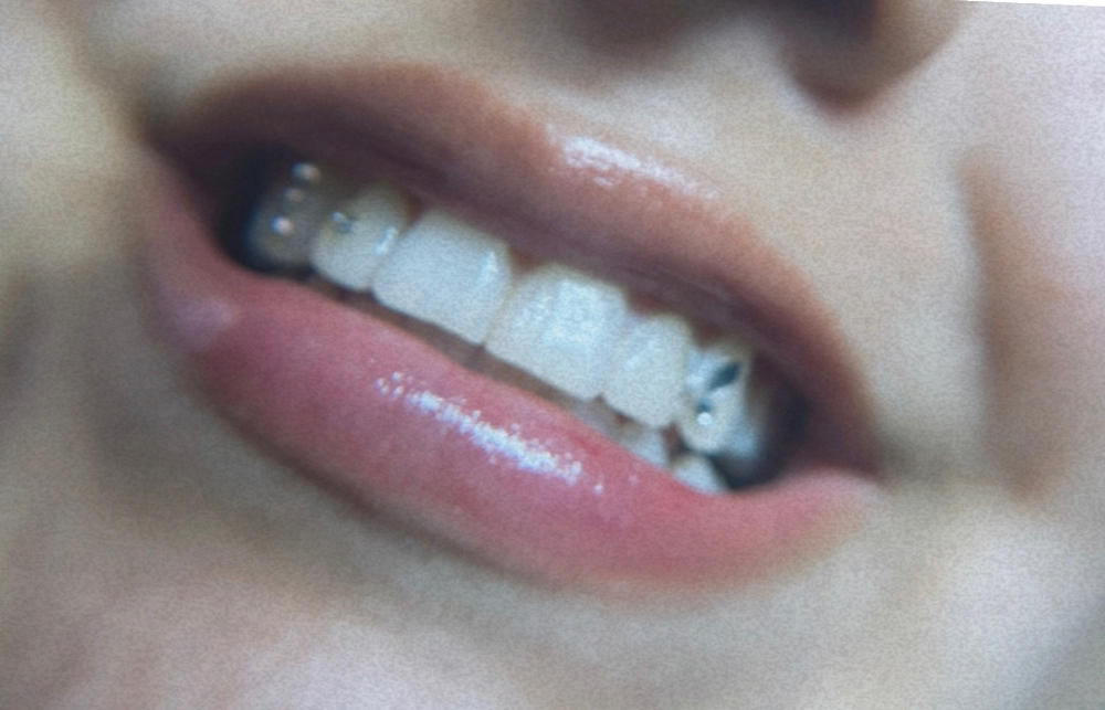 30 Mins Teeth Whitening