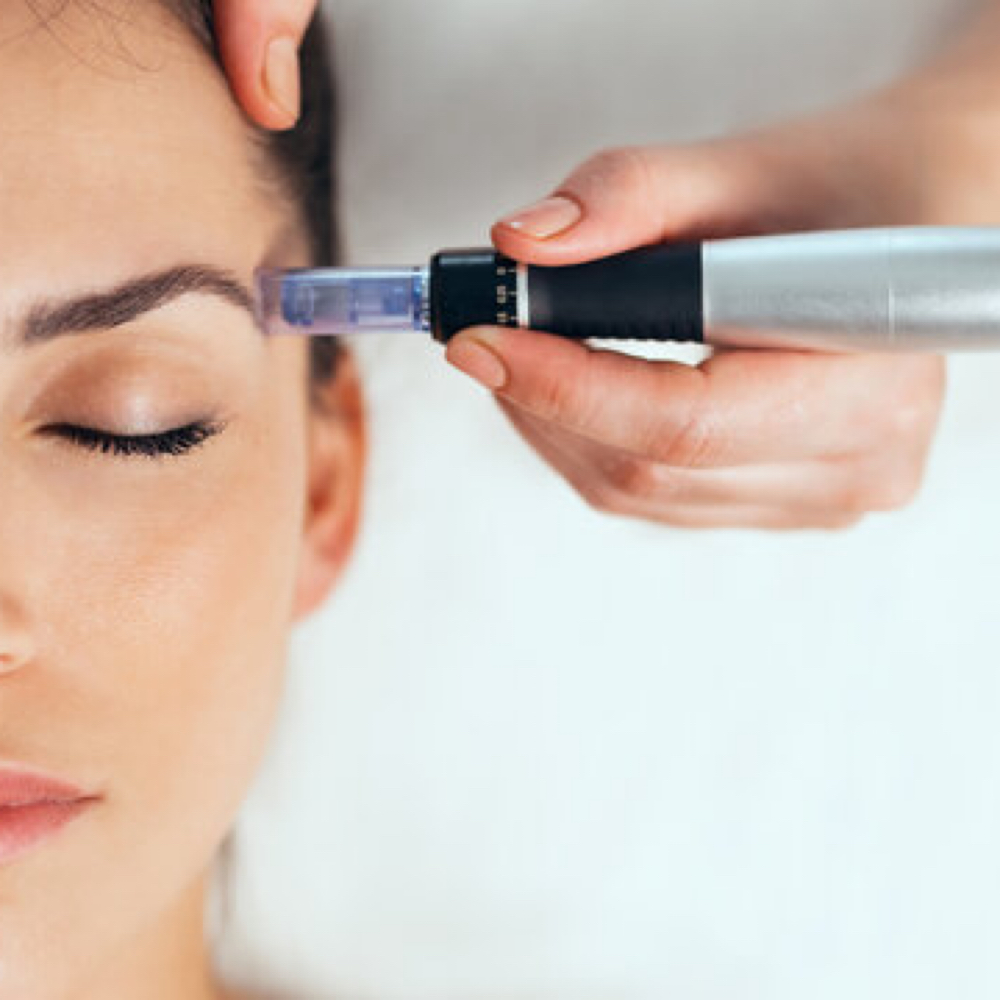 Microneedling - single session at Premier Weight Loss & Medispa in Rome, GA