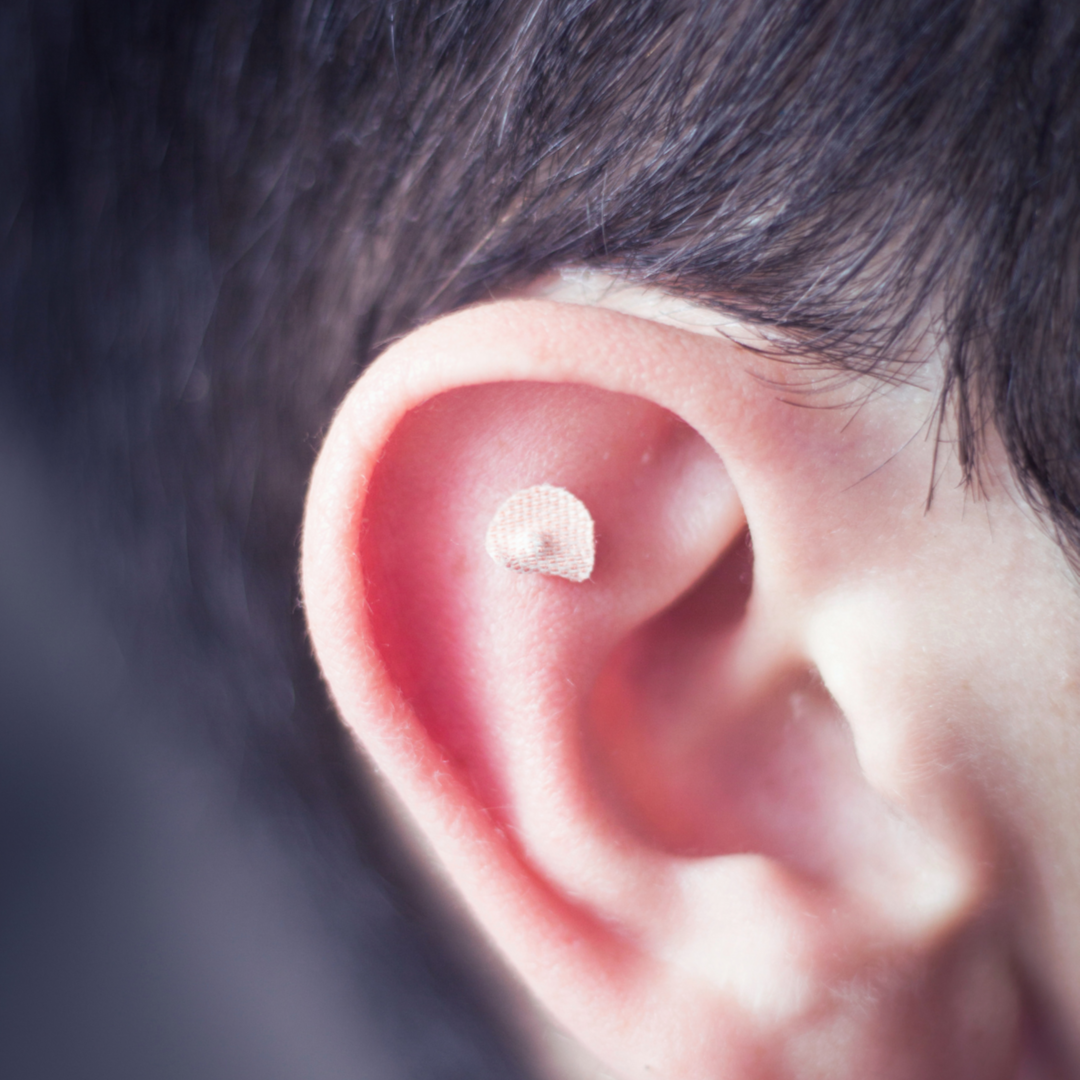 Ear Seeds at Hygiea Health in Manchester, NH