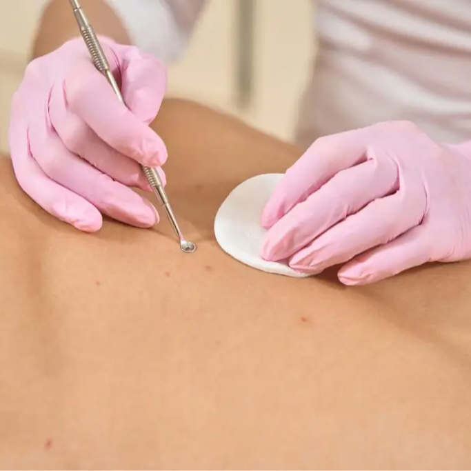 Clarifying Back Facial at AZ Brows & Skin in Scottsdale, AZ