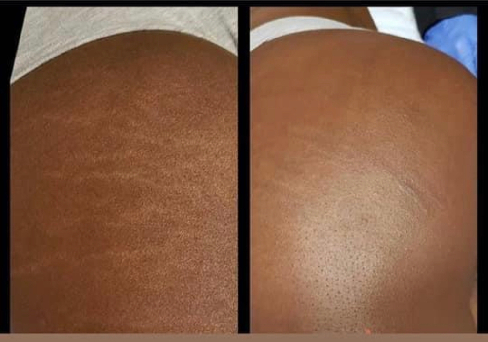 Scar/ Stretch Mark Camouflage