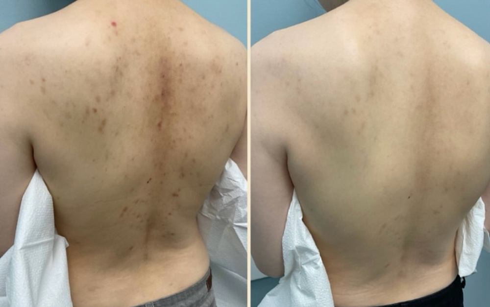 Back Acne Scars Session