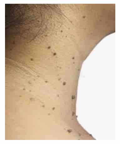 “Skin Tags Removal”