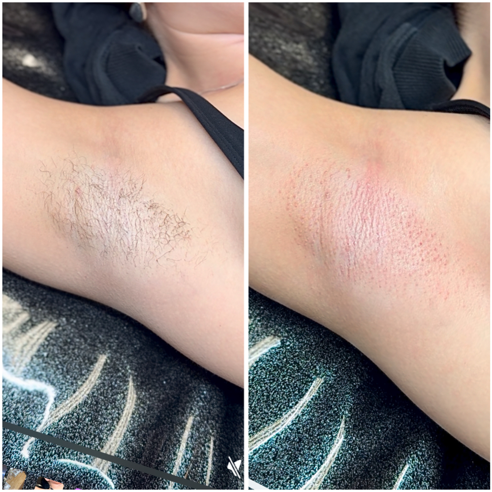 Underarms at The Skin Sanctuary in Boise, ID