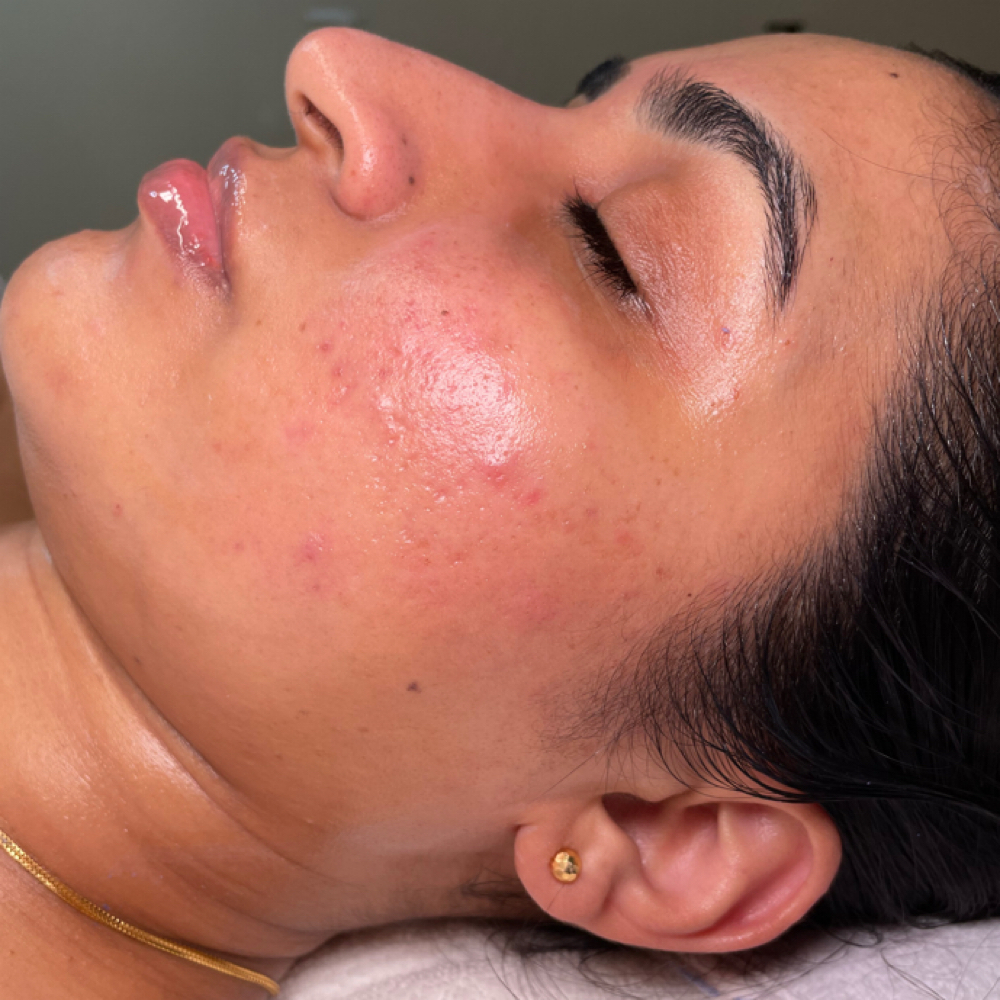 Model Call Clear Skin Reset Program at Aby’s Beauty Aesthetics in Fresno, CA