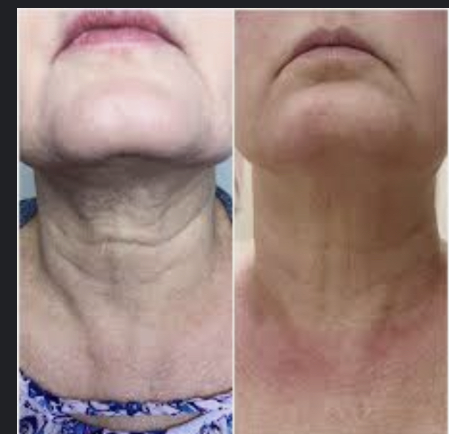 Neck Lift