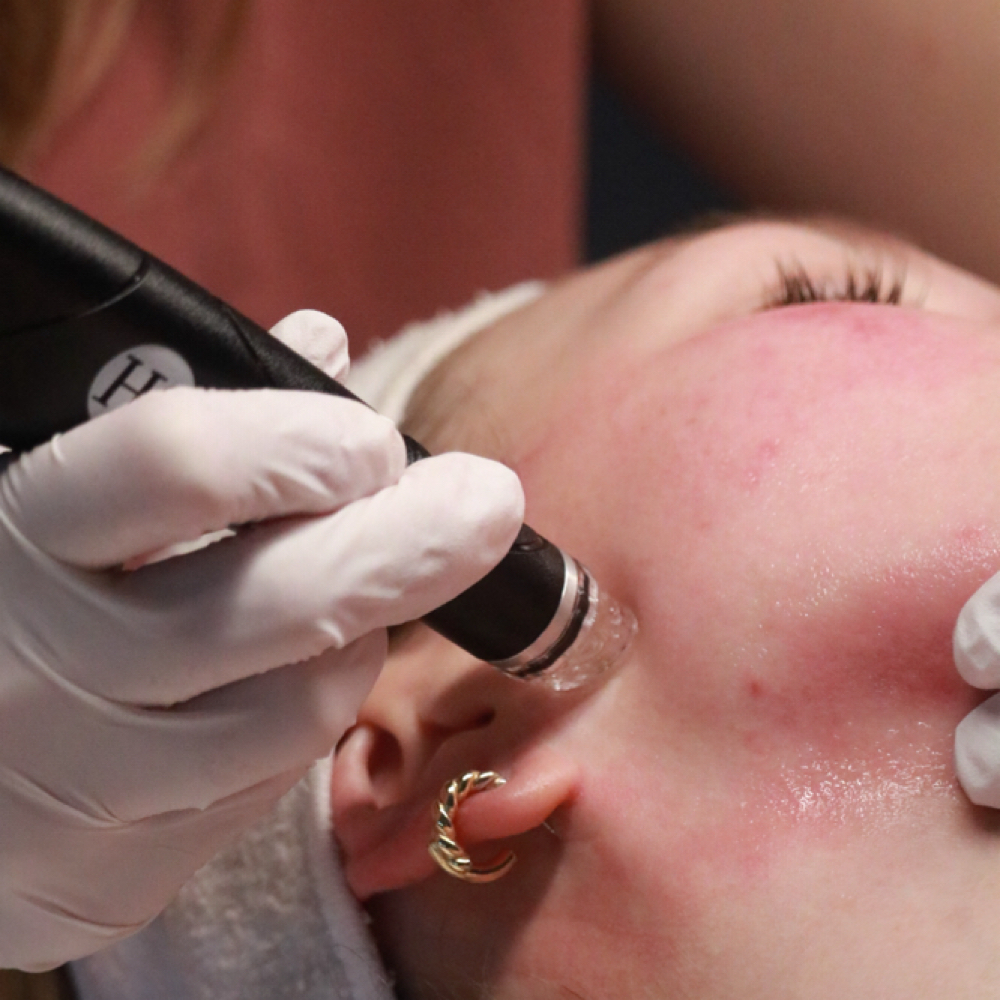 Microneedling (face) at Mirror Mirror Aesthetics in Dunkirk, IN