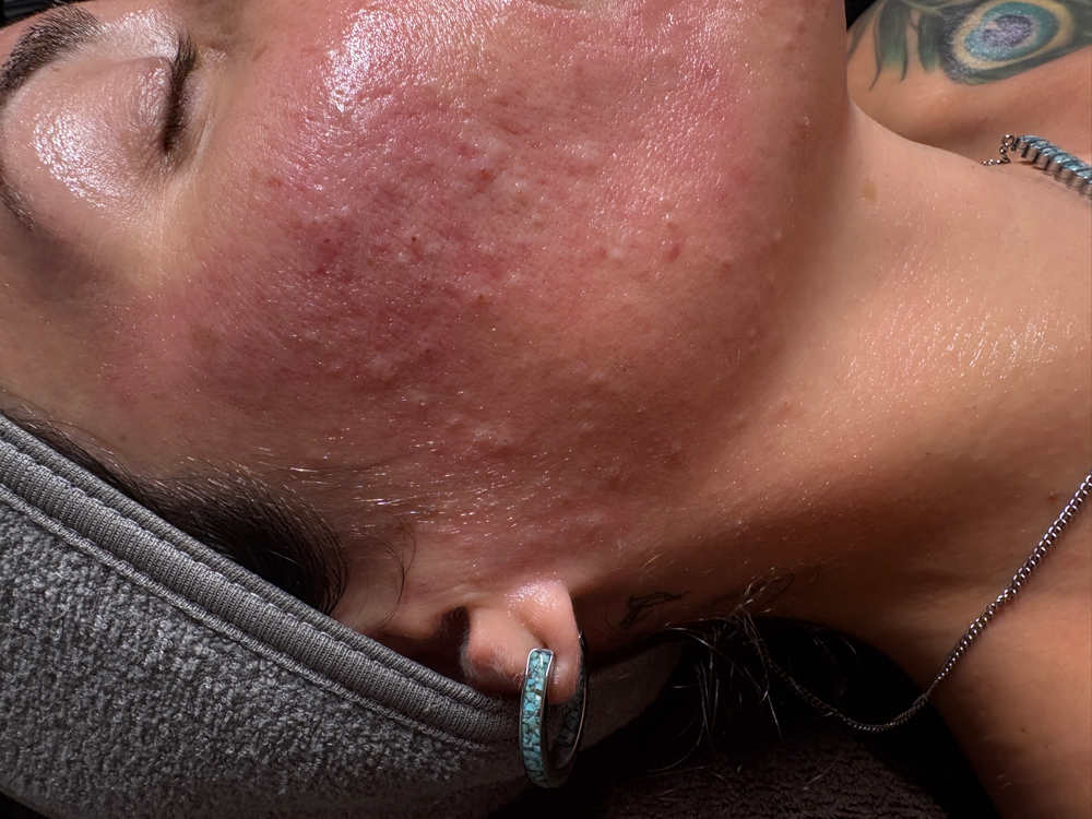 Acne Bootcamp Consultation