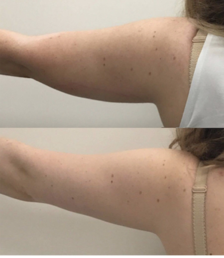 Flabby Arm Treatment Package 6