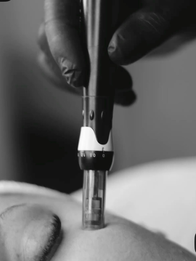 NANONEEDLING (Advanced Add On)