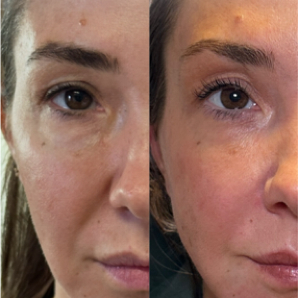 Renuva- Nonsurgical Fat Graft at Aesthetic NP Marie in Portland, OR