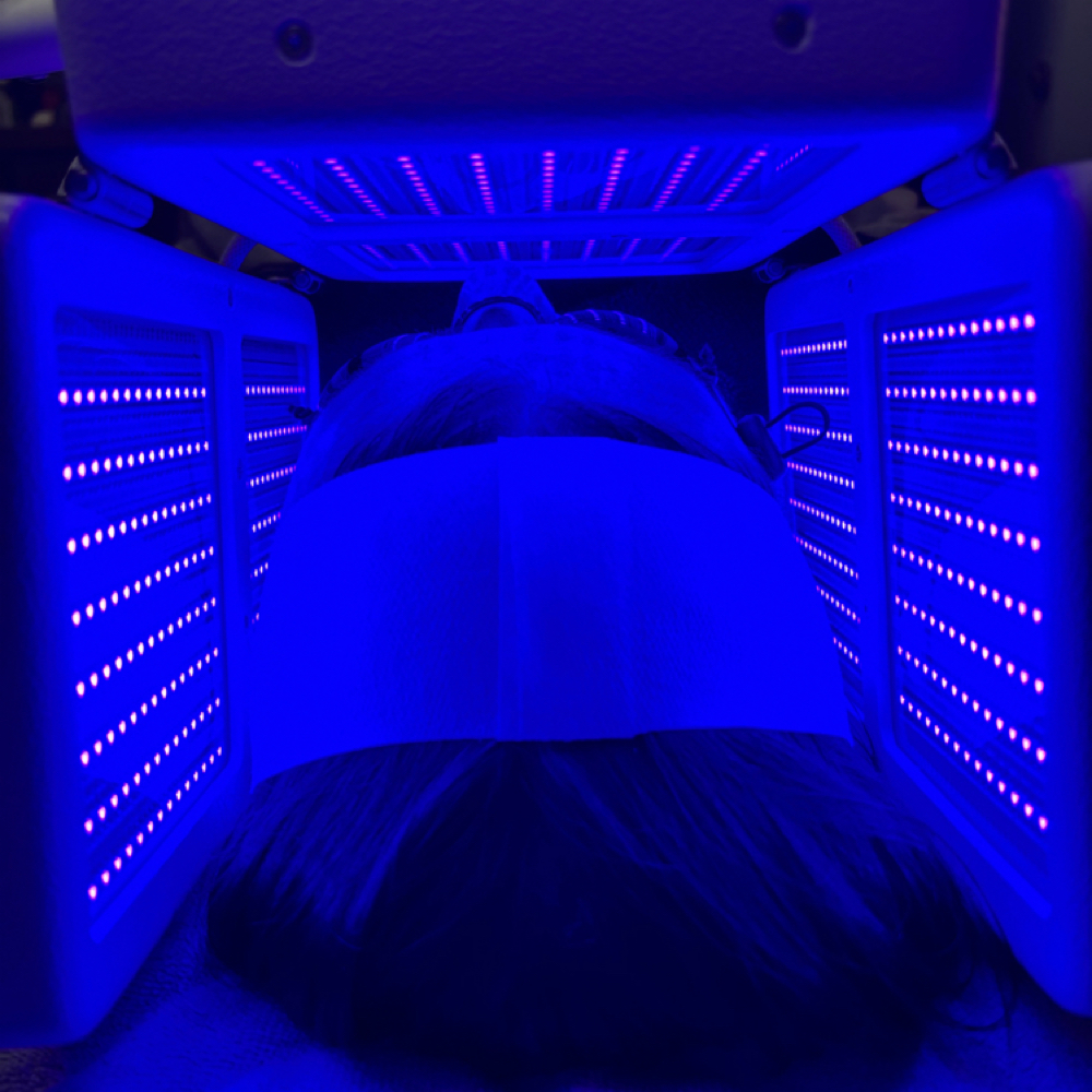 ALA 13% Photodynamic Acne Treatment at Holistic Skin Center in Edgewater, FL