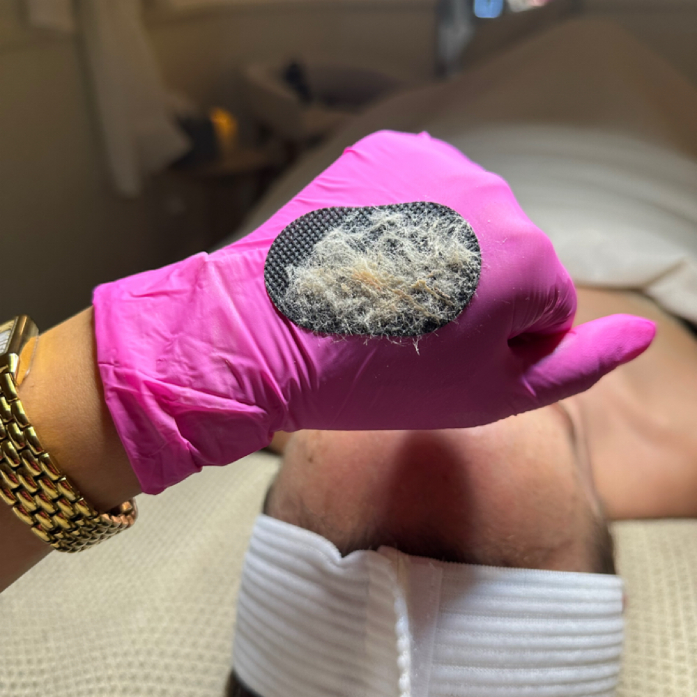 Dermaplane Add On at Clinical Skin Aesthetics in Newport Beach, CA