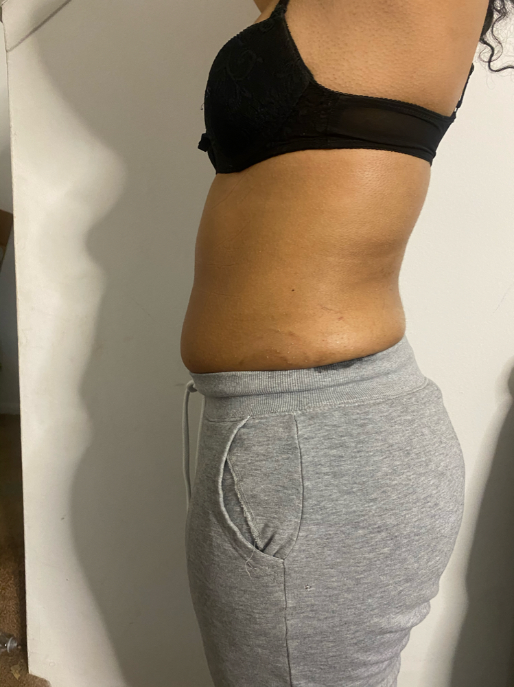 Skin Tightening