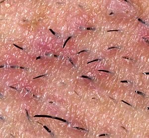 Add On - Ingrown Removal at LVB Wax Studio in Las Vegas, NV