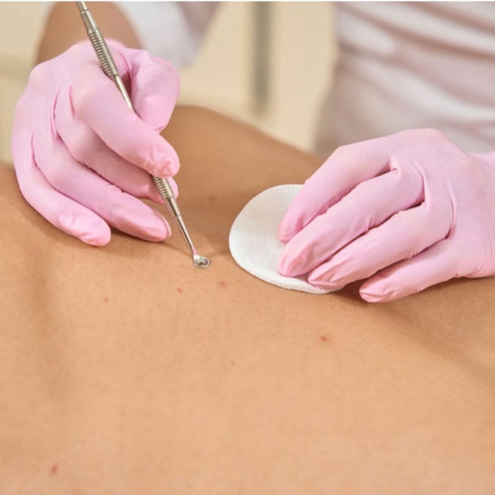 Back Hydrafacial at Angela’s Medical Aesthetics in Rockwall, TX