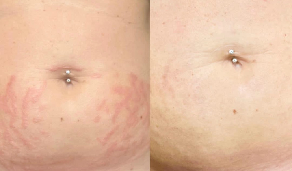 Stretch Mark Revision