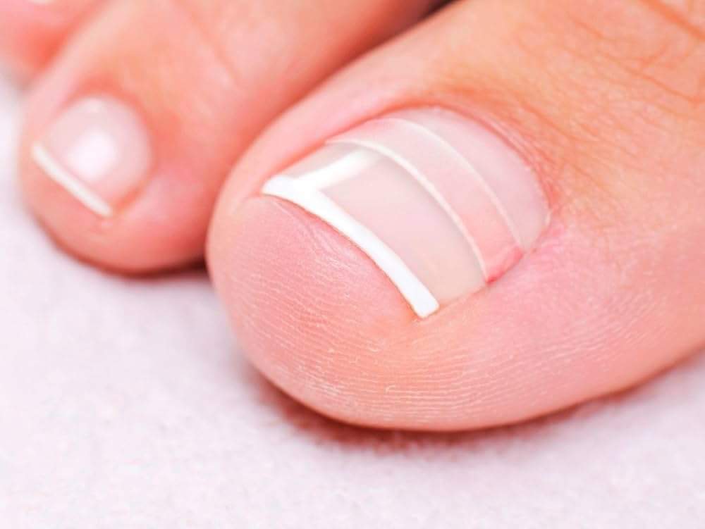 Brace Placement (1 Nail)