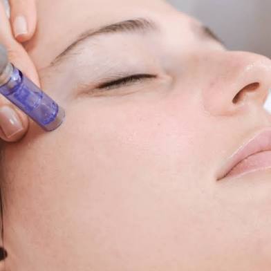Microneedling Face + Chemical Peel