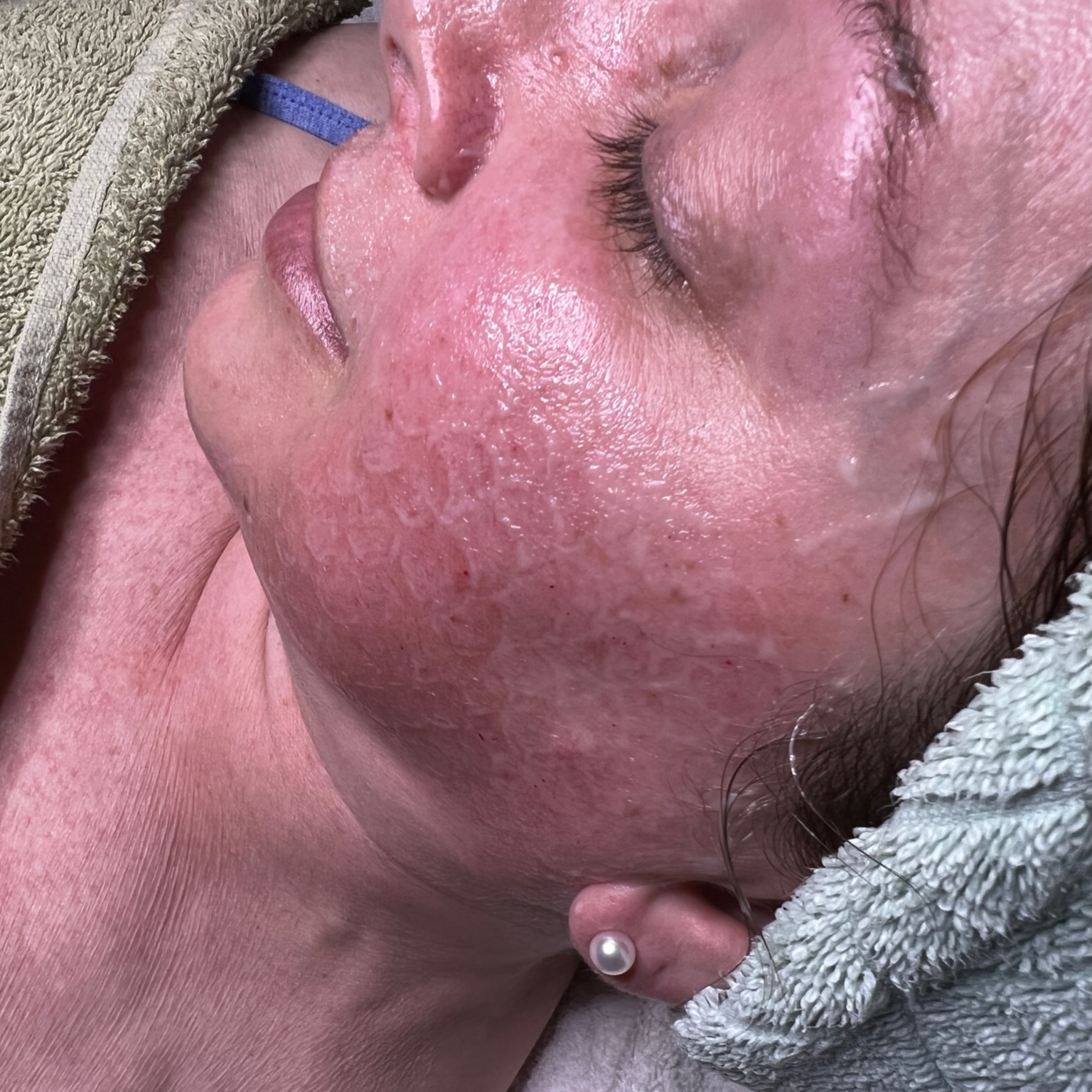 Dermaplane + Microneedling at Three Little Birds Aesthetics in Centennial, CO