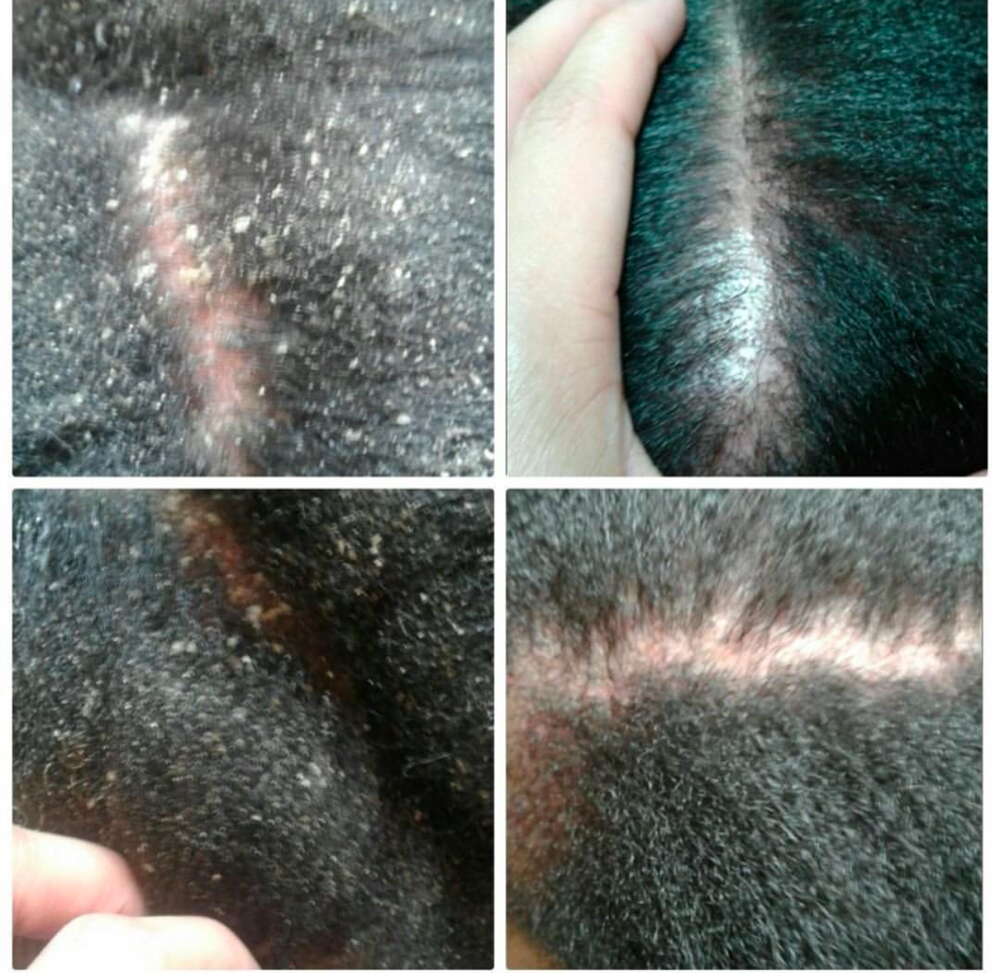 Scalp Detox