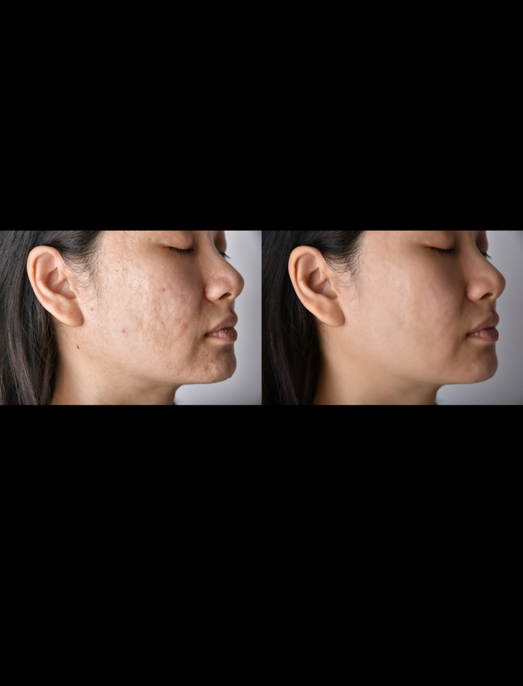 Scar Treatments