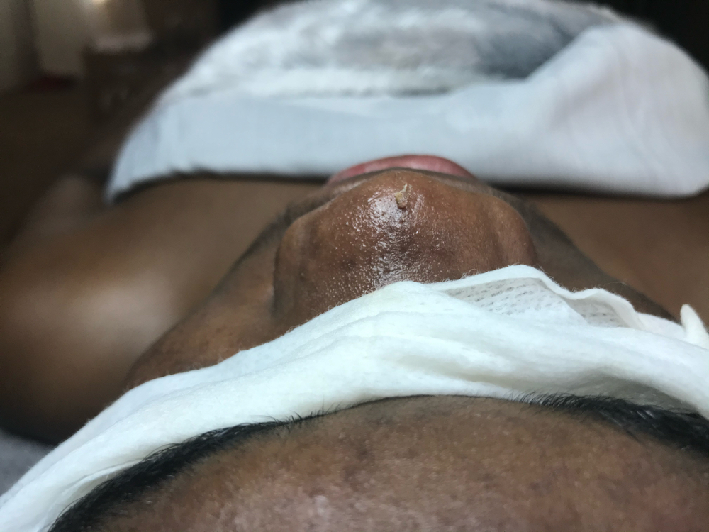 Teen Acne / Bliemish Treatments