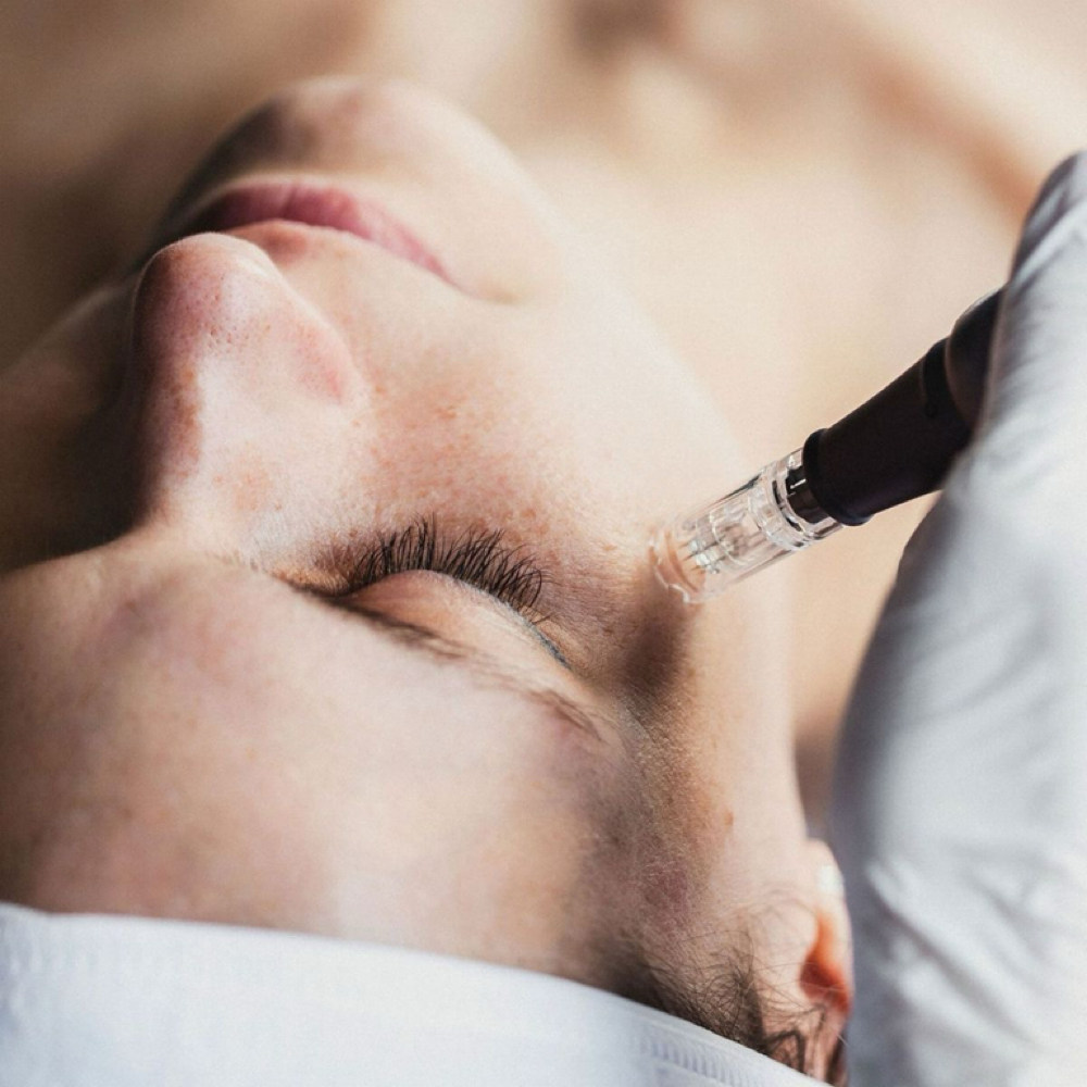 Microneedling at Aurèa Skin Atelier in Greeley, CO