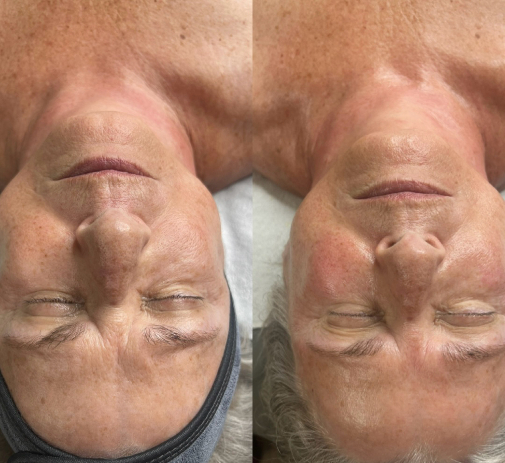 Beyond Botox Facial