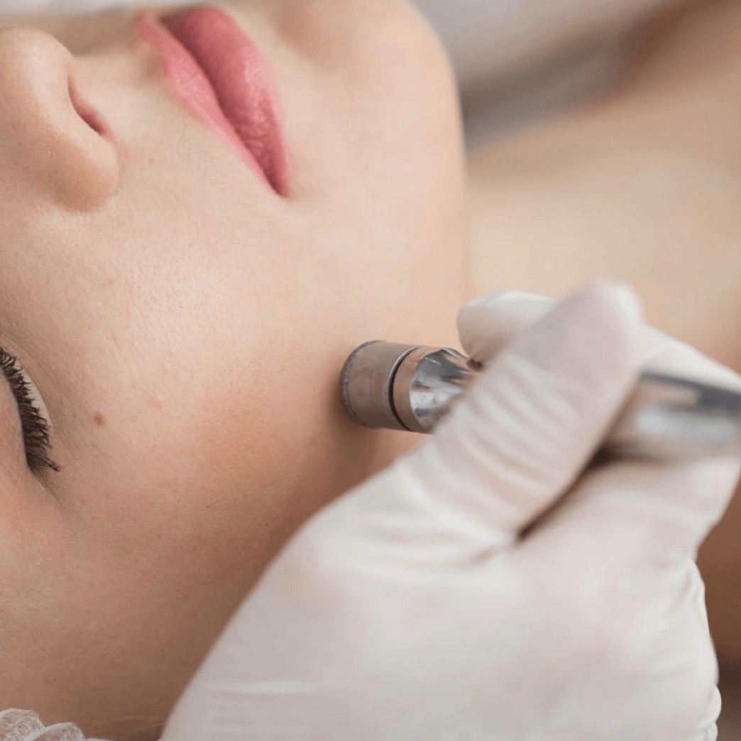 Microdermabrasion Facial at Golden Hour Esthetics in Tullahoma, TN