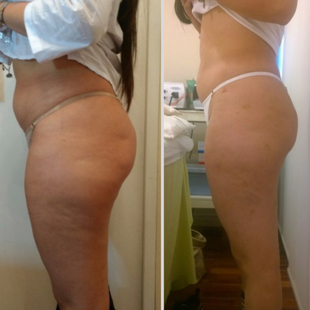 Brazilian Body Sculpting at Glow By Clau in Chicago, IL