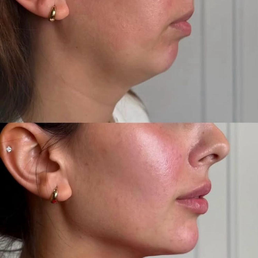 Facial Balancing Signature Filler at Ultimate Health Spa in Leesburg, FL