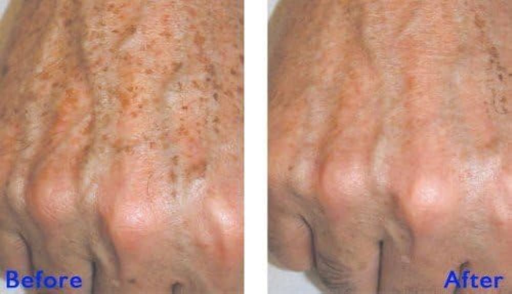 Jessner Miami Chemical Peel