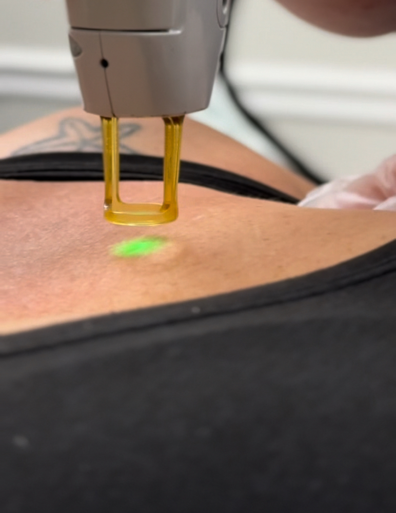 Laser Consultation
