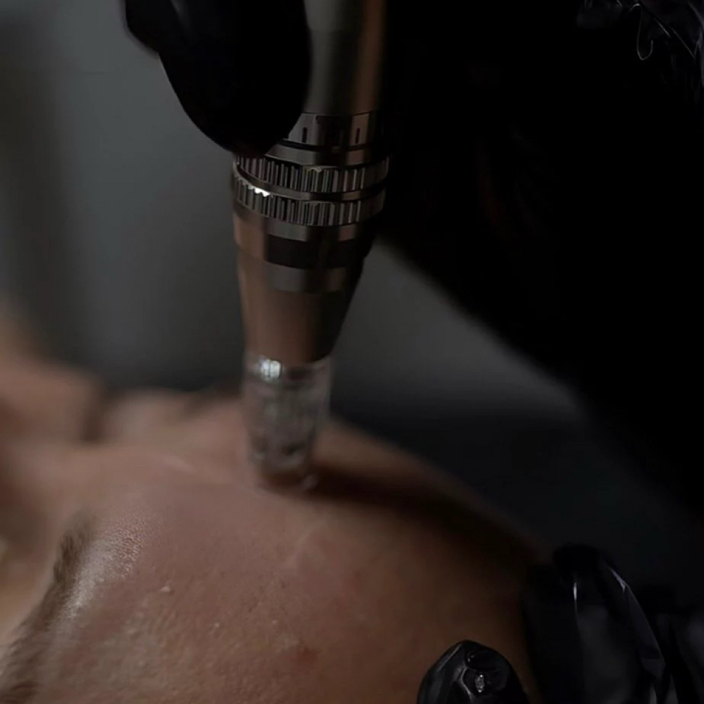 Microneedling at Cox Clinic & Aesthetics in Antlers, OK