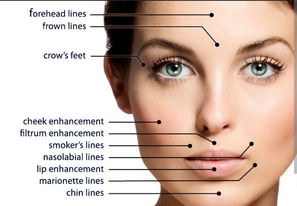 Juvéderm Voluma XC $950