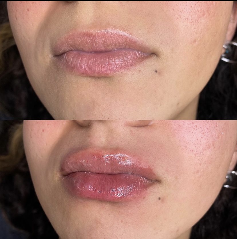 Hyaluron Pen Lip Filler