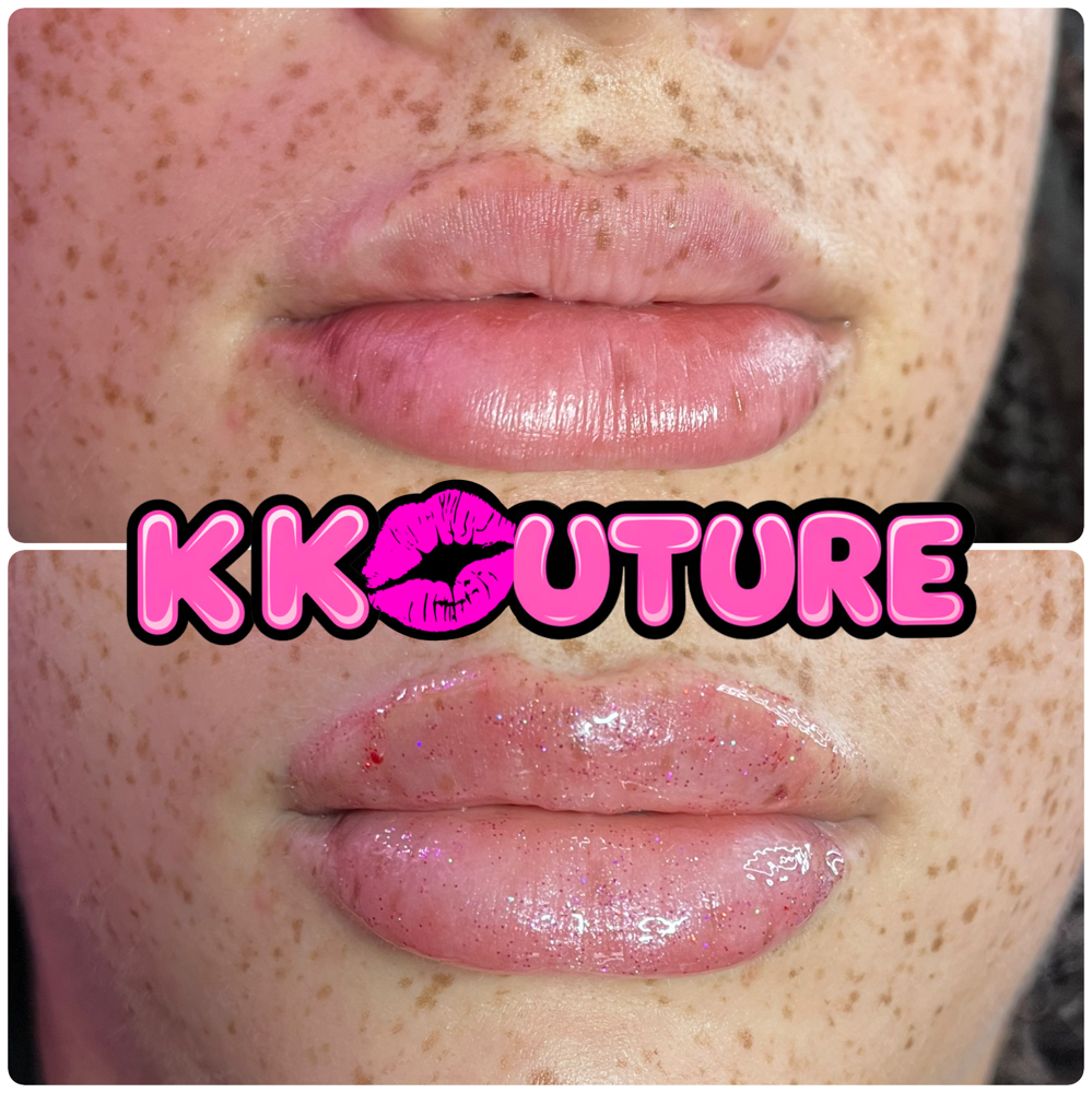 .5 ML Lip Filler