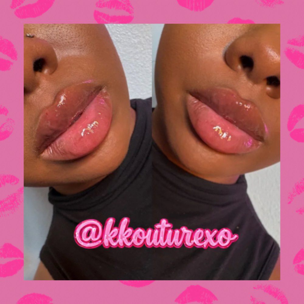 .5 ML Lip Filler at k kouture in Fort Worth, TX