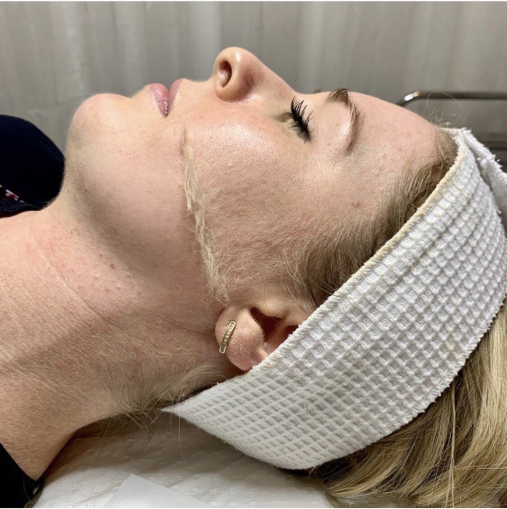 Dermaplane Follow-Up Visit