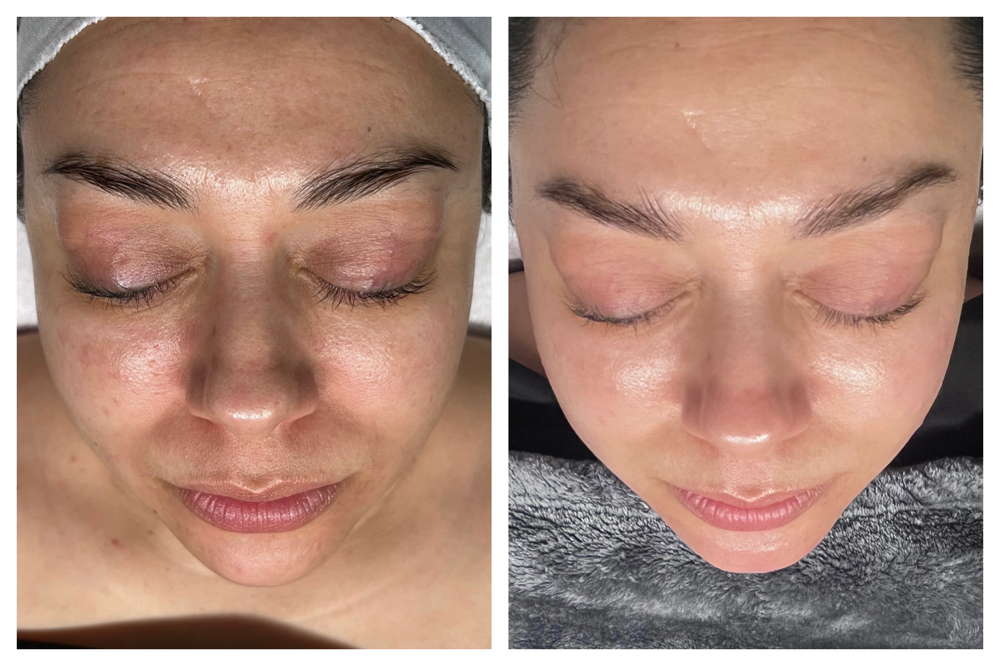 Hydrofacial (upgrade)